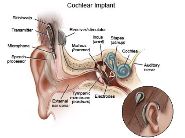 cochlearImpant_420x315_rd1_enIL